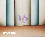 drilling technology-trepanning drilling technology-trepanning